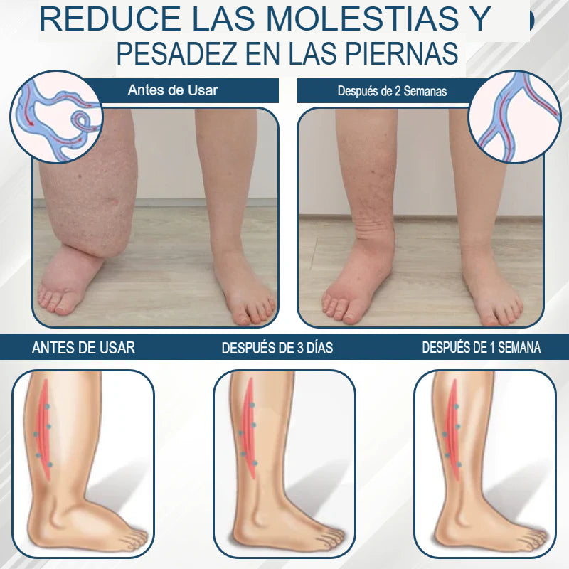 Hoygi® Black Cumin – Alivio Inmediato para Piernas Hinchadas, Pesadas y con Dolor (Edema)