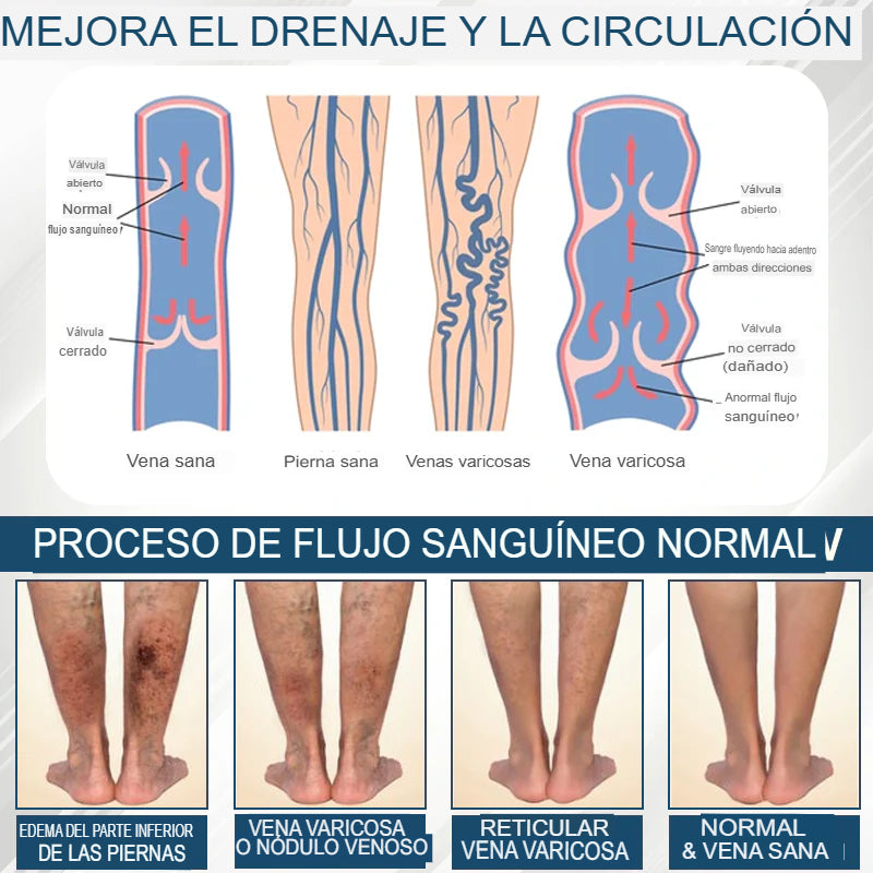 Hoygi® Black Cumin – Alivio Inmediato para Piernas Hinchadas, Pesadas y con Dolor (Edema)