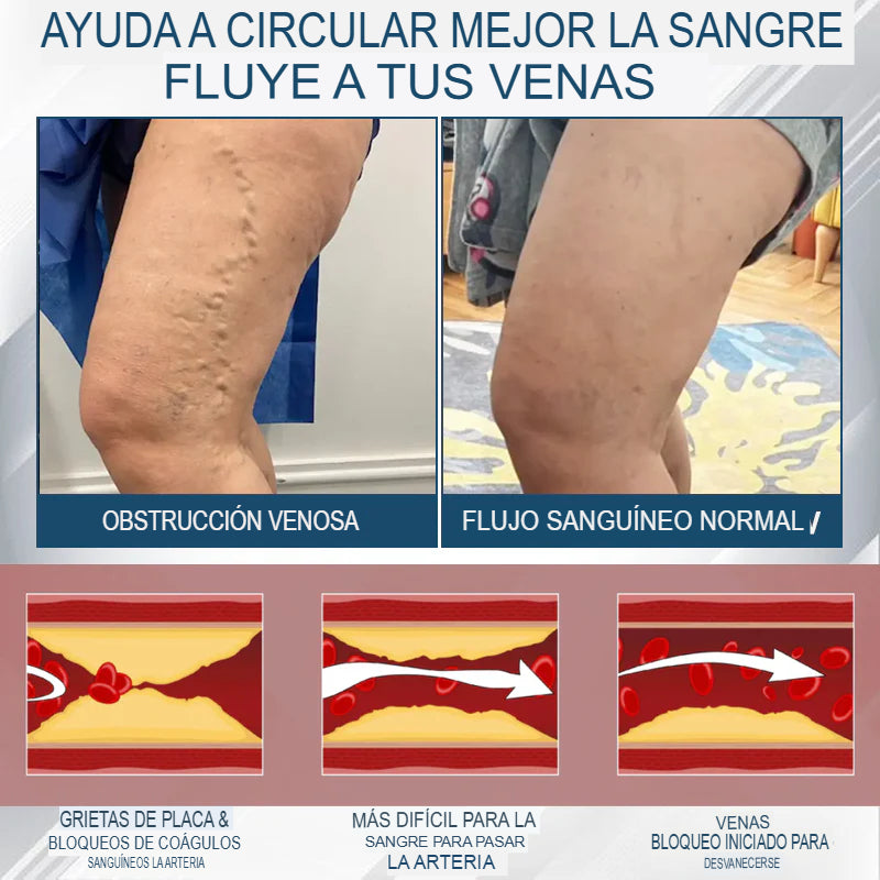 Hoygi® Black Cumin – Alivio Inmediato para Piernas Hinchadas, Pesadas y con Dolor (Edema)
