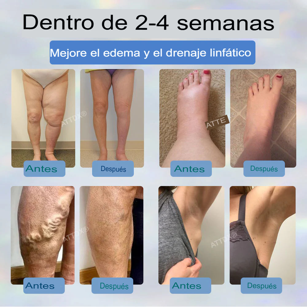 Hoygi® Black Cumin – Alivio Inmediato para Piernas Hinchadas, Pesadas y con Dolor (Edema)
