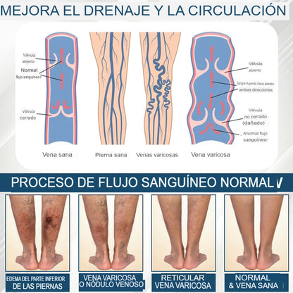 Hoygi® Black Cumin – Alivio Inmediato para Piernas Hinchadas, Pesadas y con Dolor (Edema)